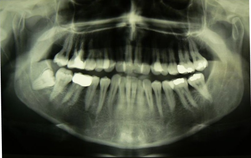 Invisalign - Ortodonzia invisibile